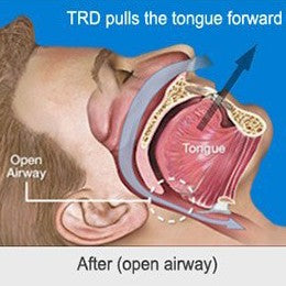 Tongue Stabiliser