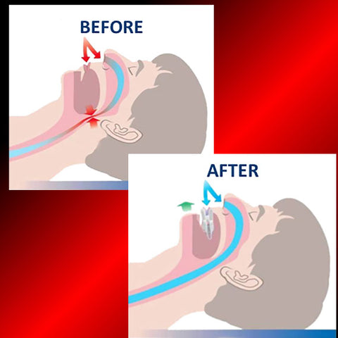 Snorblok® NitePro2 Anti Snoring Mouthguard